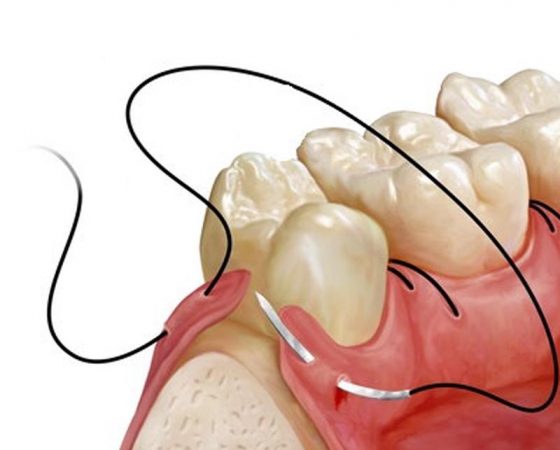 Chirurgie orala dentara