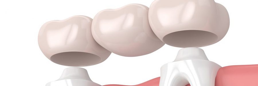 Implant dentar sau Punte dentara?